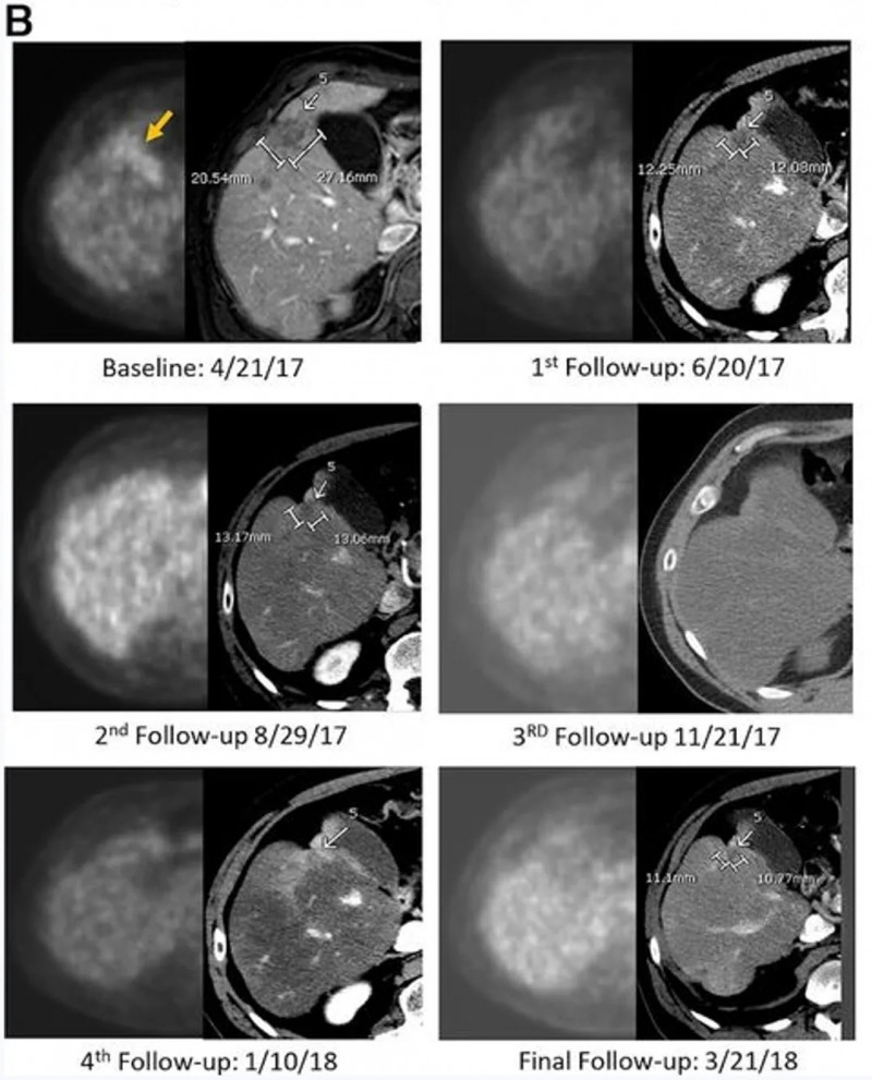 CEA CAR-T治疗胰腺癌肝转移的效果