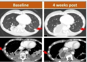 CT041治疗胃癌的效果
