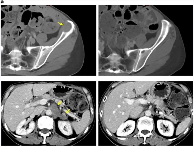 SEL-TIL联合PD-1治疗胆管癌的效果