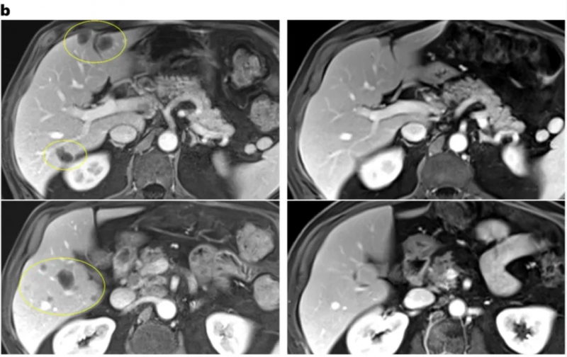 SEL-TIL联合PD-1治疗直肠癌的效果