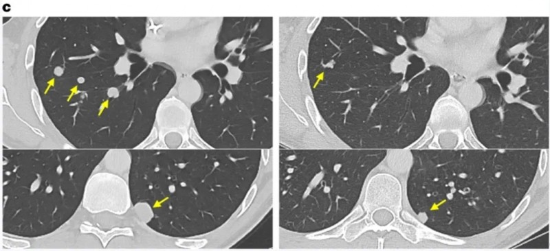 SEL-TIL联合PD-1治疗结肠癌的效果