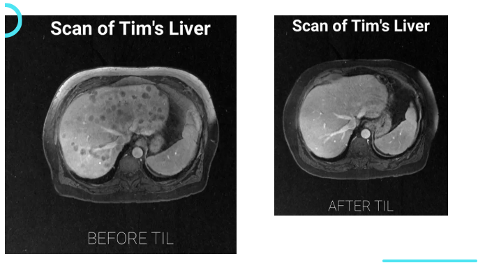 TIL细胞疗法治疗黑色素瘤肝转移的效果