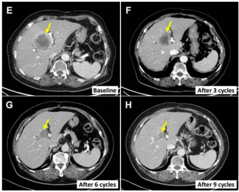 SMT-NK治疗干外胆管癌的效果
