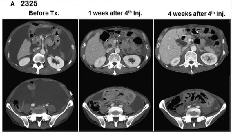 Vγ9Vδ2T细胞疗法治疗胃癌腹水的效果