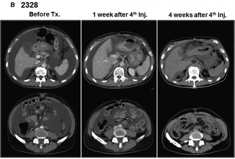 Vγ9Vδ2T细胞疗法治疗胃癌的效果