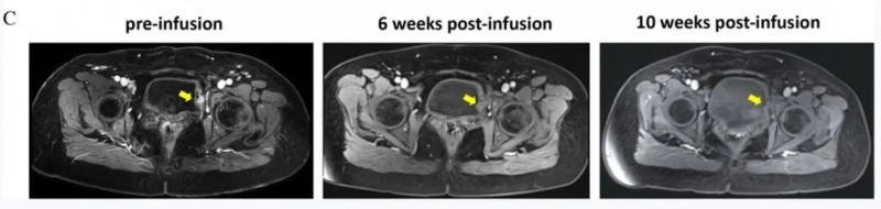 TIL细胞疗法联合PD-1治疗复发性宫颈癌的效果