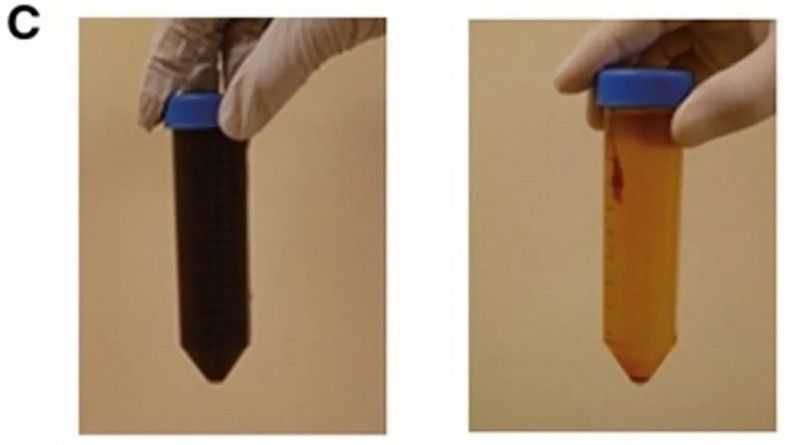 Vγ9Vδ2T细胞疗法治疗胃癌腹水水质的变化