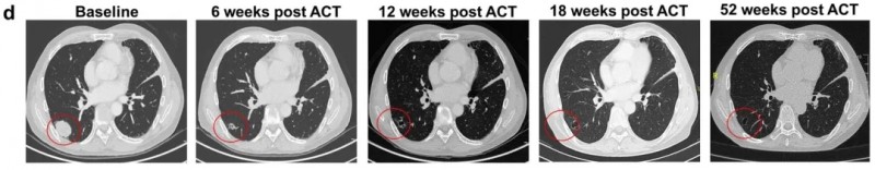 CAR-T细胞疗法联合mRNA疫苗治疗肺转移灶的效果