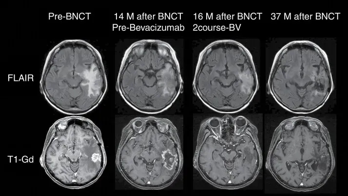 硼中子俘获疗法治疗胶质母细胞瘤的效果