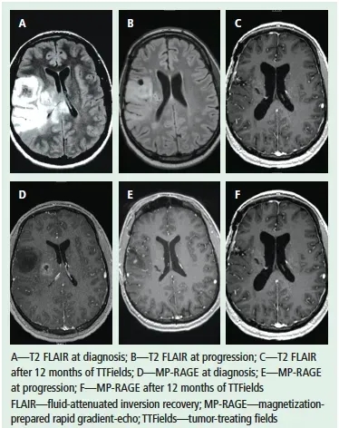电场疗法治疗胶质母细胞瘤的效果