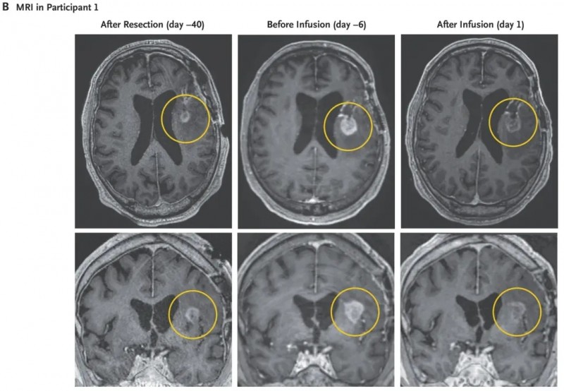 CARv3-TEAM-E细胞疗法治疗复发胶质母细胞瘤的效果