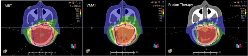 质子治疗儿童脑瘤