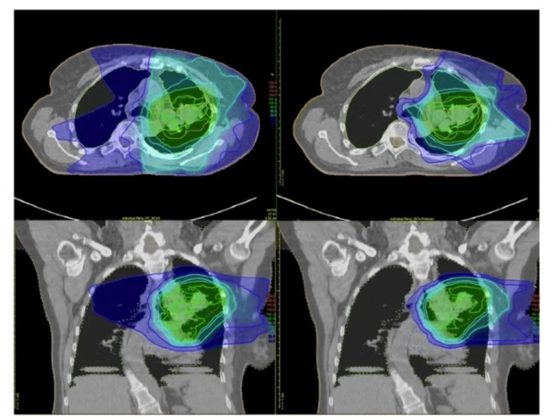 质子治疗与传统放疗对比