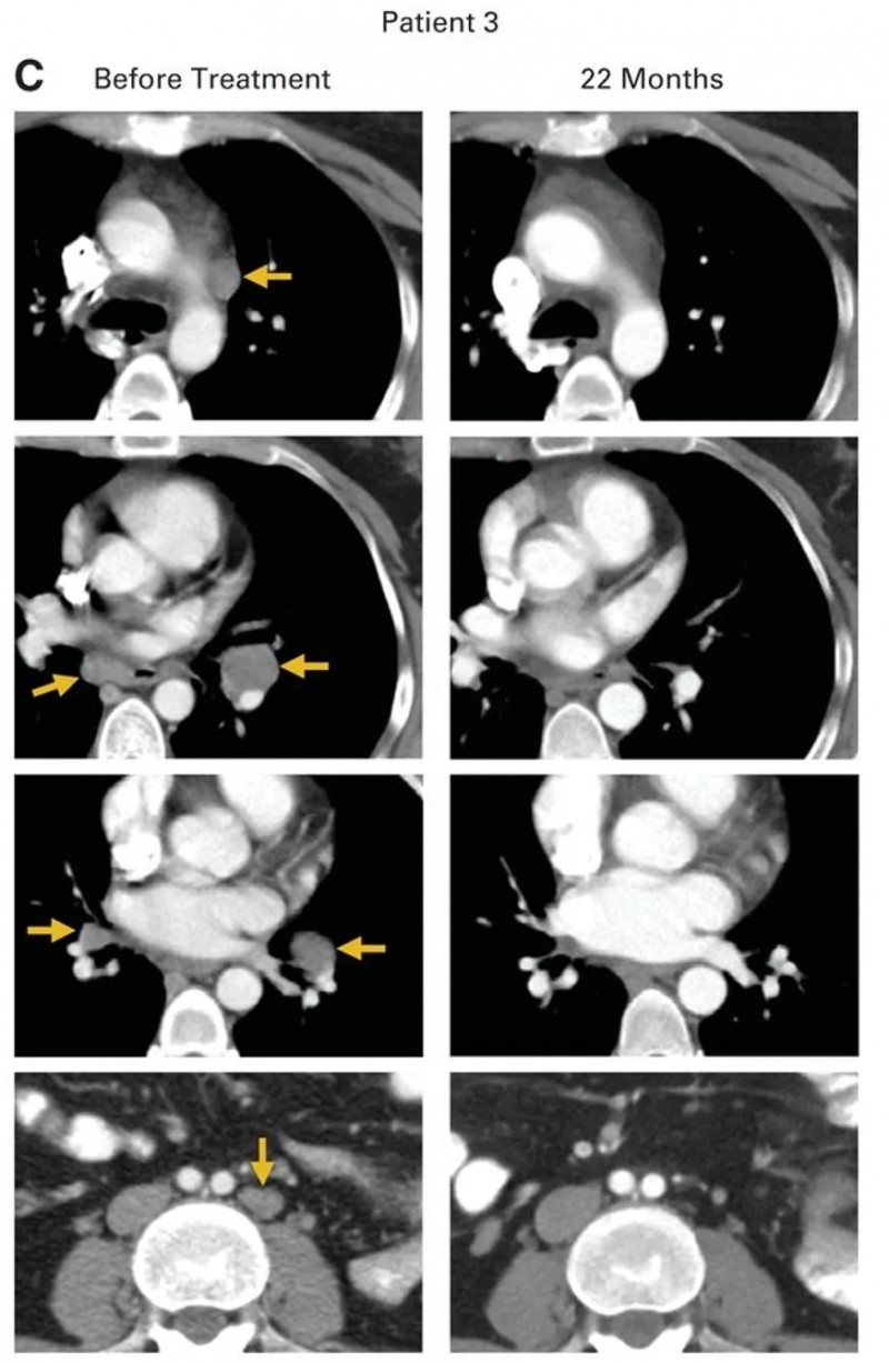 HPV-TIL疗法治疗转移性鳞状细胞癌的效果