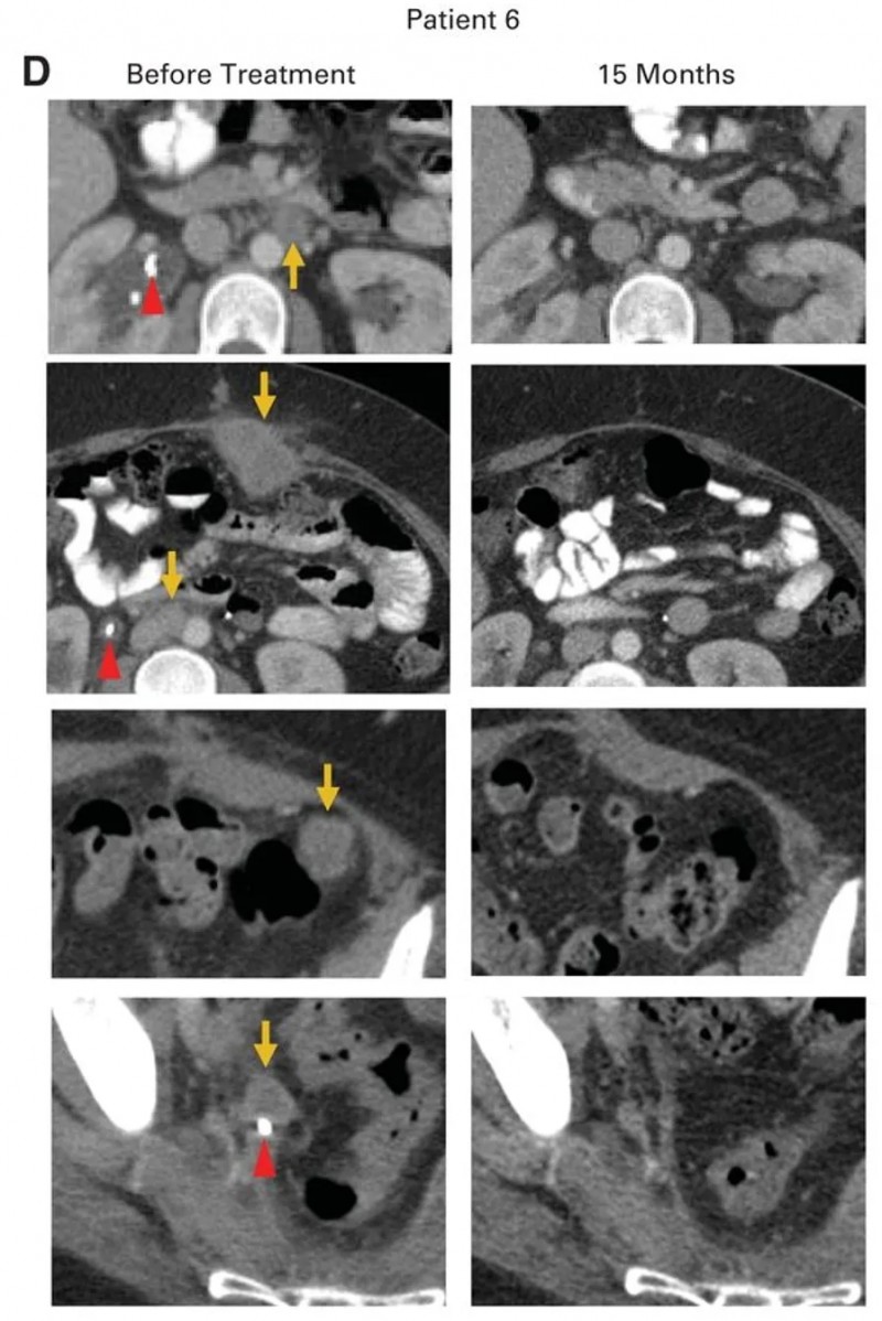 HPV-TIL治疗转移性腺癌的效果