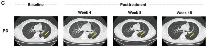 GPC3 CAR-T细胞疗法治疗肝癌的效果