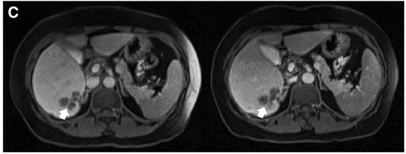 CEA CAR-T细胞疗法治疗结直肠癌肝转移的效果