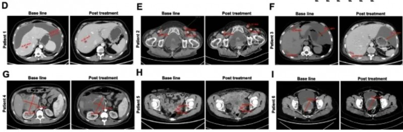 KT032 CAR-T细胞疗法治疗效果
