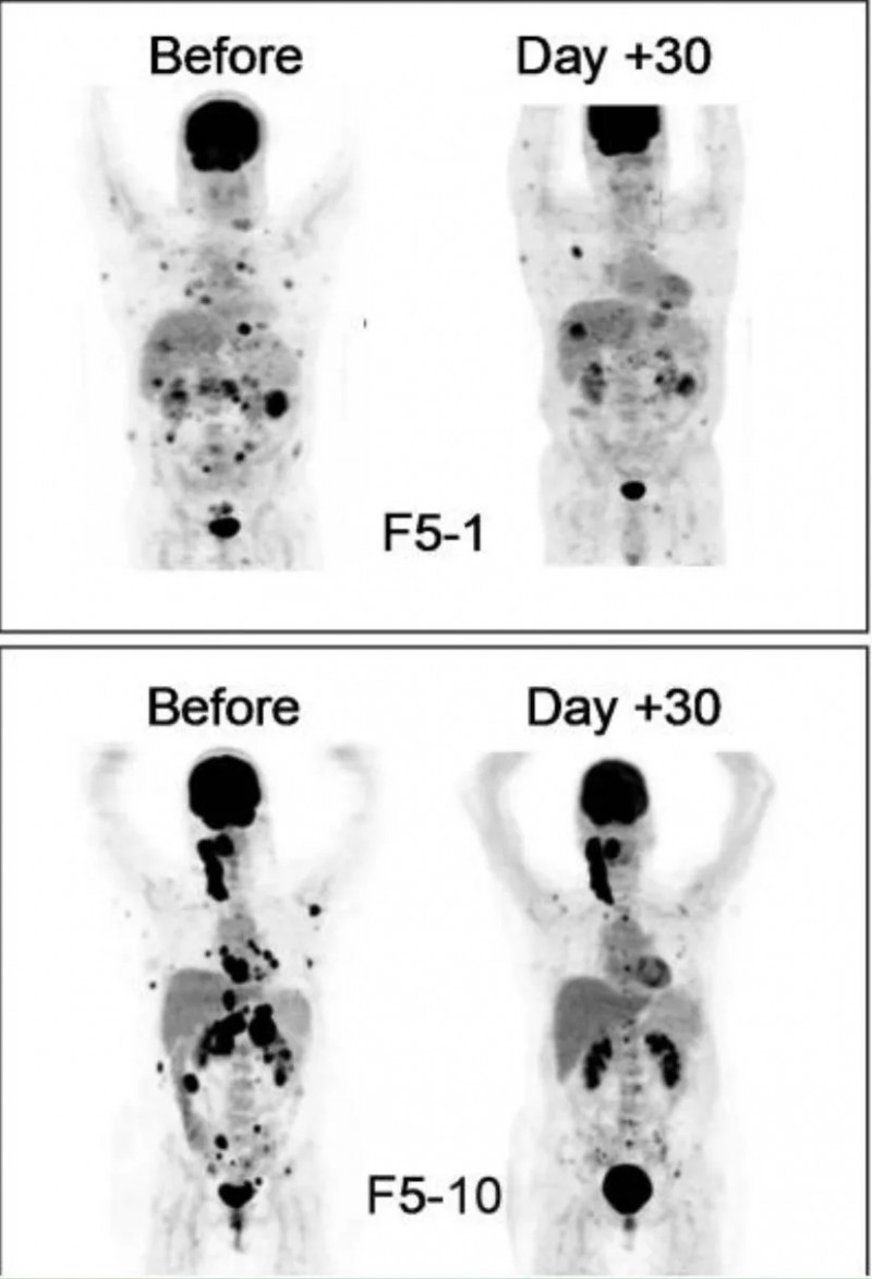 TCR-T细胞联合DC疫苗治疗黑色素瘤的效果