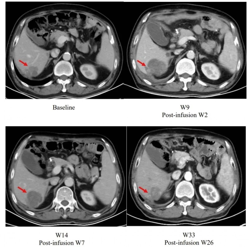 satri-cel治疗胃癌的效果