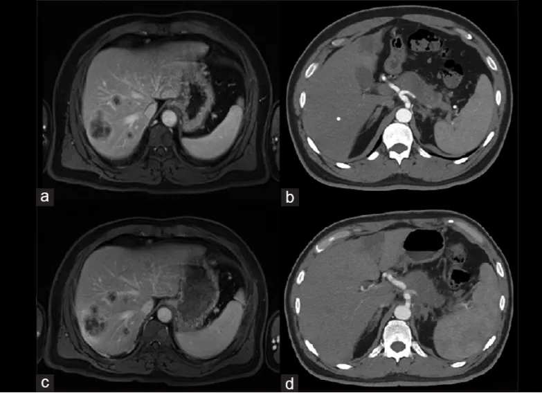 Robo1-CAR-NK细胞疗法治疗晚期胰腺癌的效果