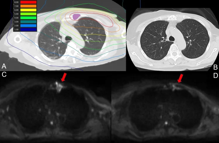 BNCT治疗乳腺癌的效果
