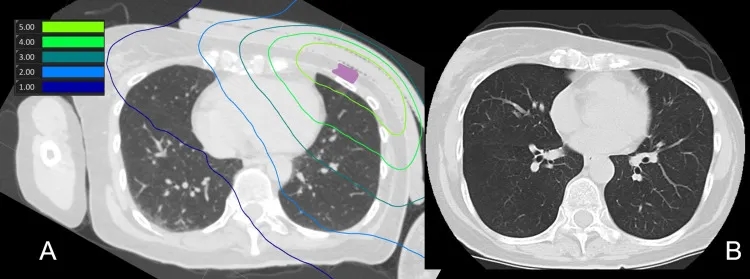 BNCT治疗乳腺癌的效果