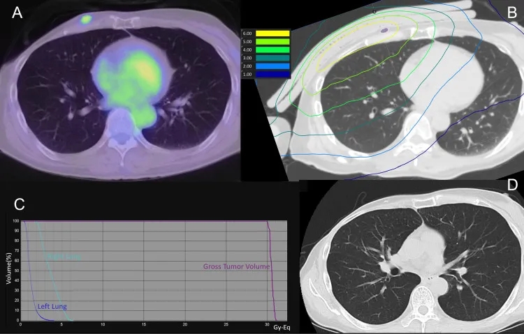 BNCT治疗乳腺癌的效果