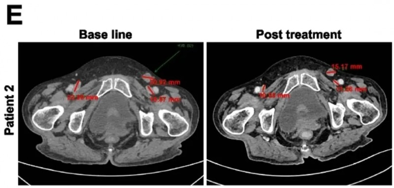 KT032 CAR-T治疗效果