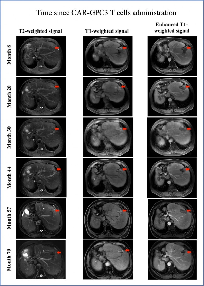 GPC3 CAR-T治疗肝癌的效果