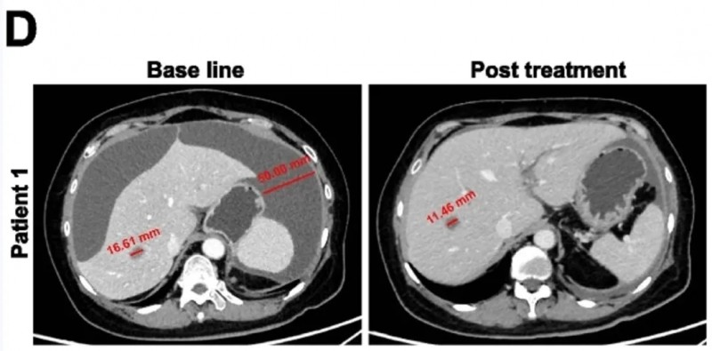 KT032 CAR-T治疗效果