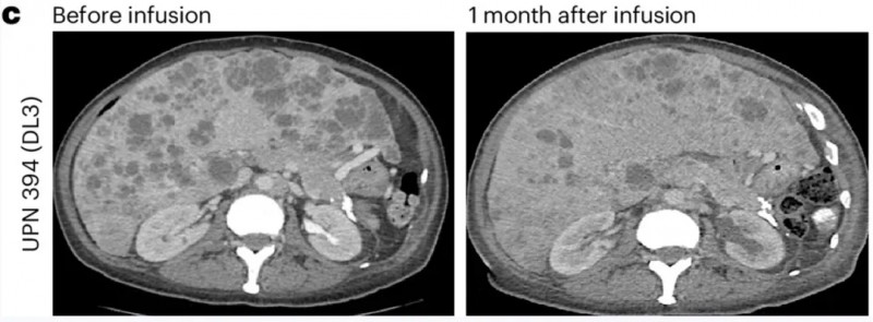 PSCA-CAR-T治疗前列腺癌的效果