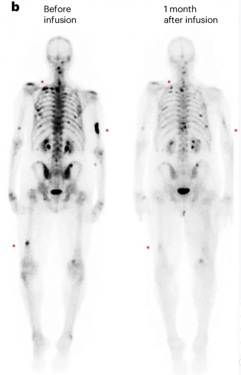 PSCA-CAR-T治疗前列腺癌转移的效果