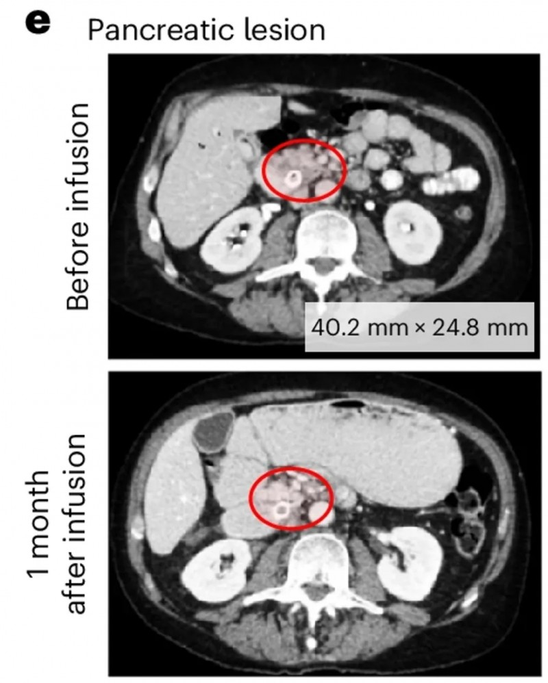 PSCA-CAR-T治疗前列腺癌的效果