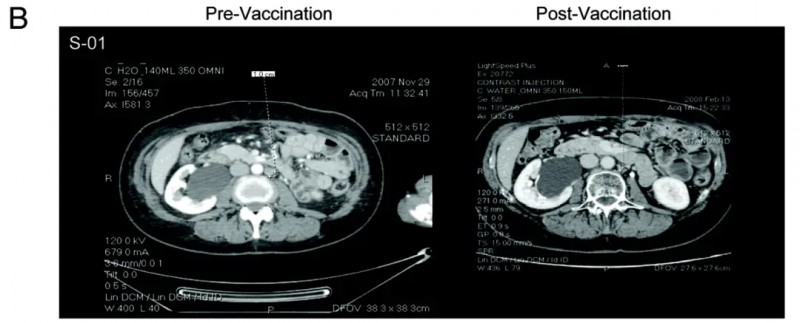 细胞疗法治疗晚期卵巢癌的效果