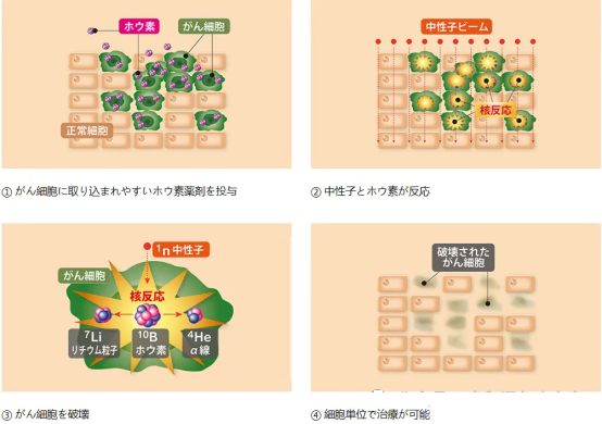 日本BNCT硼中子俘获疗法治疗癌症，正在悄然改变患者的命运