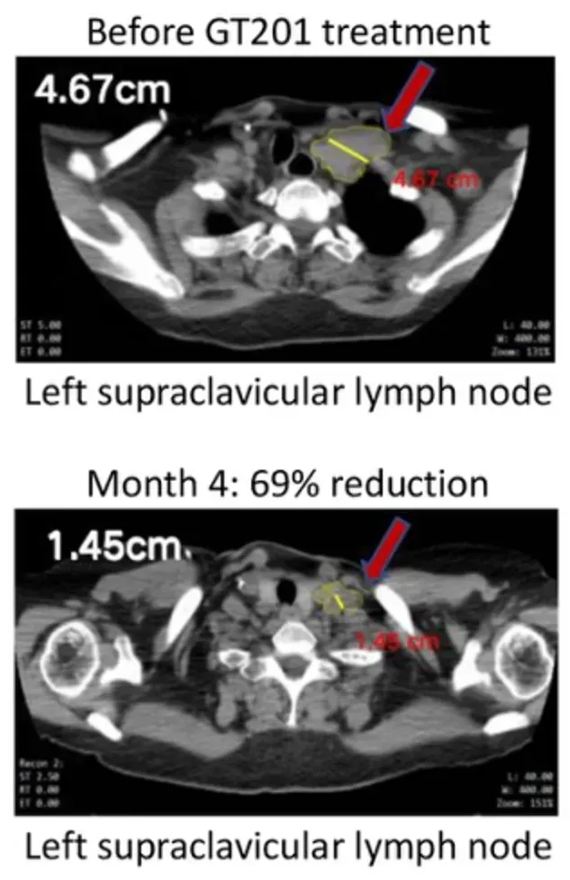 GT201治疗实体瘤的效果