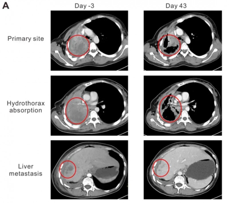 NY-ESO-1 TCR-T细胞疗法治疗肺癌的效果