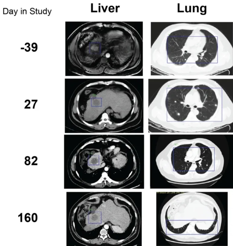 TCRm T细胞疗法治疗转移性肝癌的效果