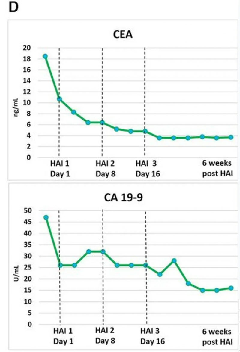 CEA CAR-T治疗胰腺癌的肿瘤标志物变化