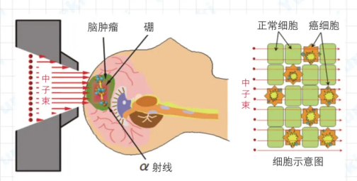 硼中子治疗脑瘤