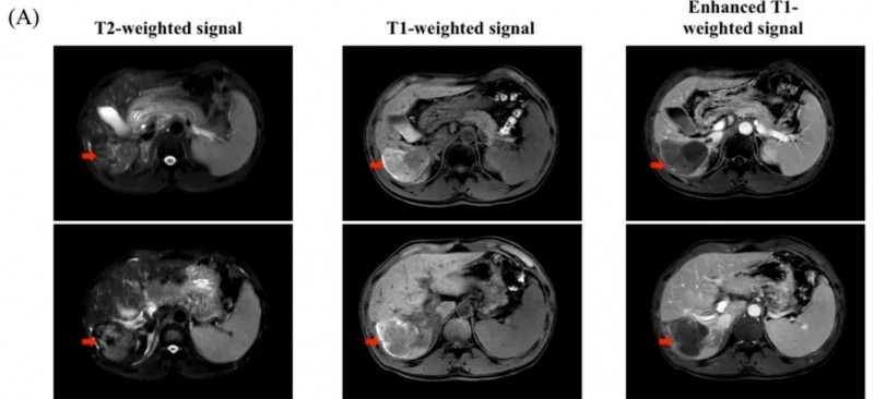C-CAR031治疗肝癌的效果