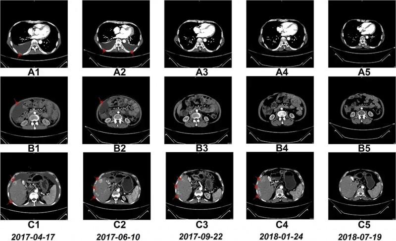 NK细胞疗法治疗肝癌的效果