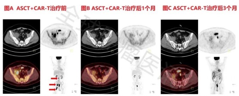ASCT联合CAR-T治疗TP53突变滤泡性淋巴瘤的效果