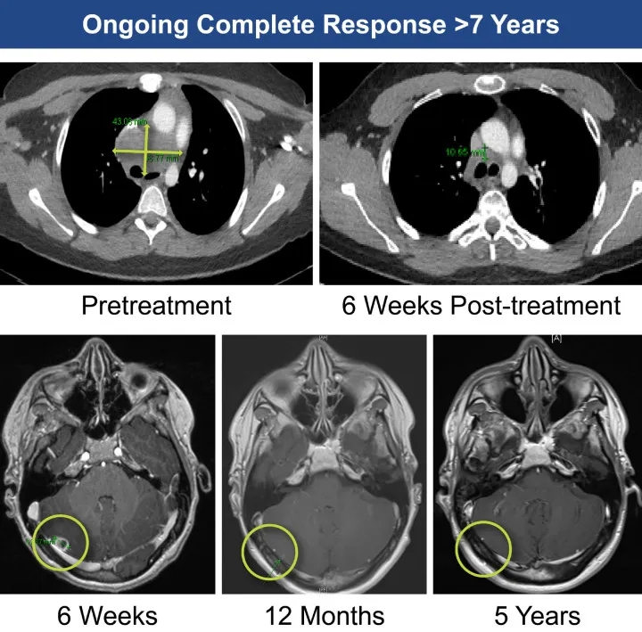 TIL细胞疗法治疗黑色素瘤的效果