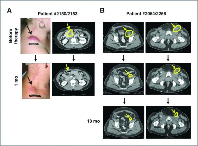 TIL细胞疗法治疗黑色素瘤的效果