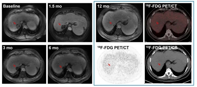 C-CAR031 CAR-T疗法治疗肝癌的效果