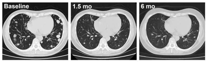 C-CAR031 CAR-T疗法治疗肝癌的效果