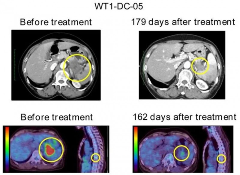 WT1-DC疫苗治疗胰腺癌的效果