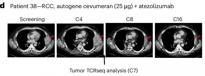 BNT122治疗肾癌的效果